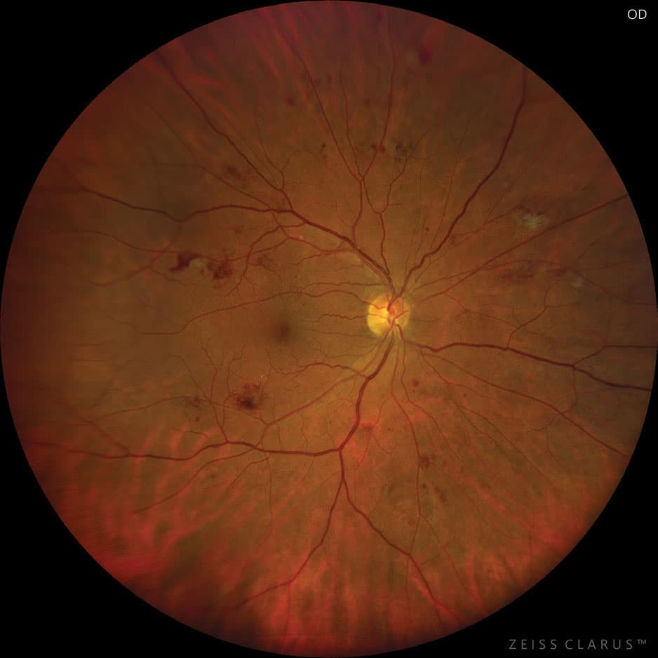Diabetic Retinopathy Example - Right Eye