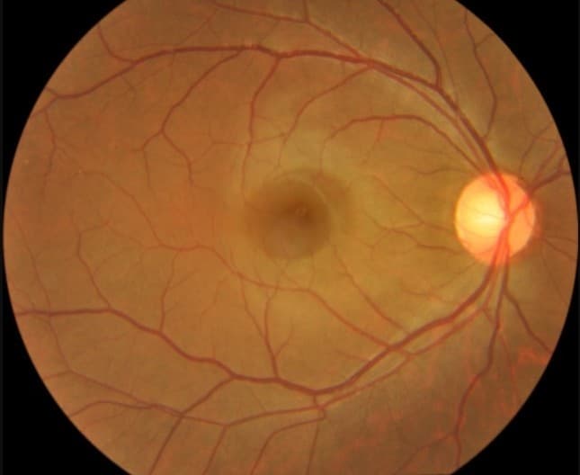 Glaucoma Example - Left Eye